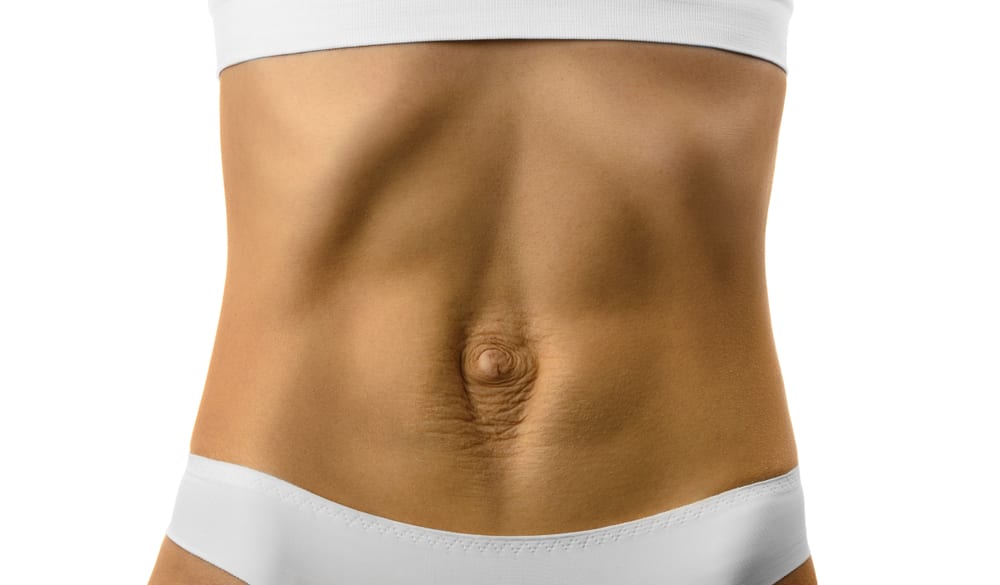 Diastasis Recti Emsculpt