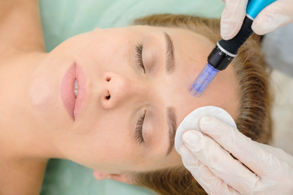 Microneedling Temecula