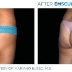 skinney-emsculpt-before-and-after-4
