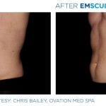 skinney-emsculpt-before-and-after-7