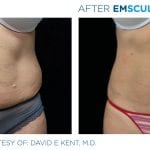 skinney-emsculpt-before-and-after-9