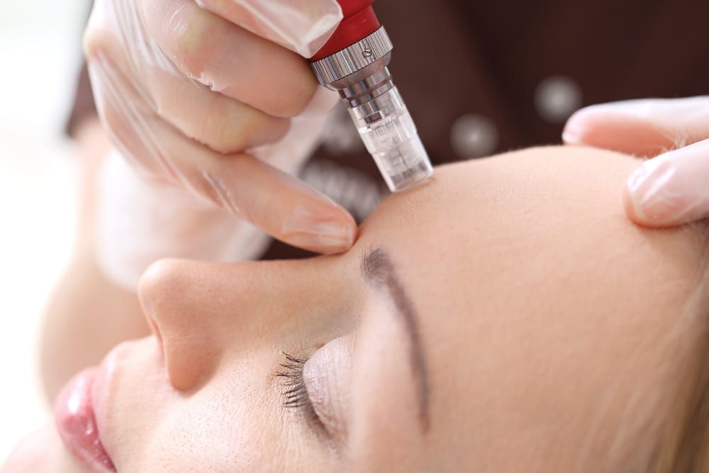 Microneedling San Diego