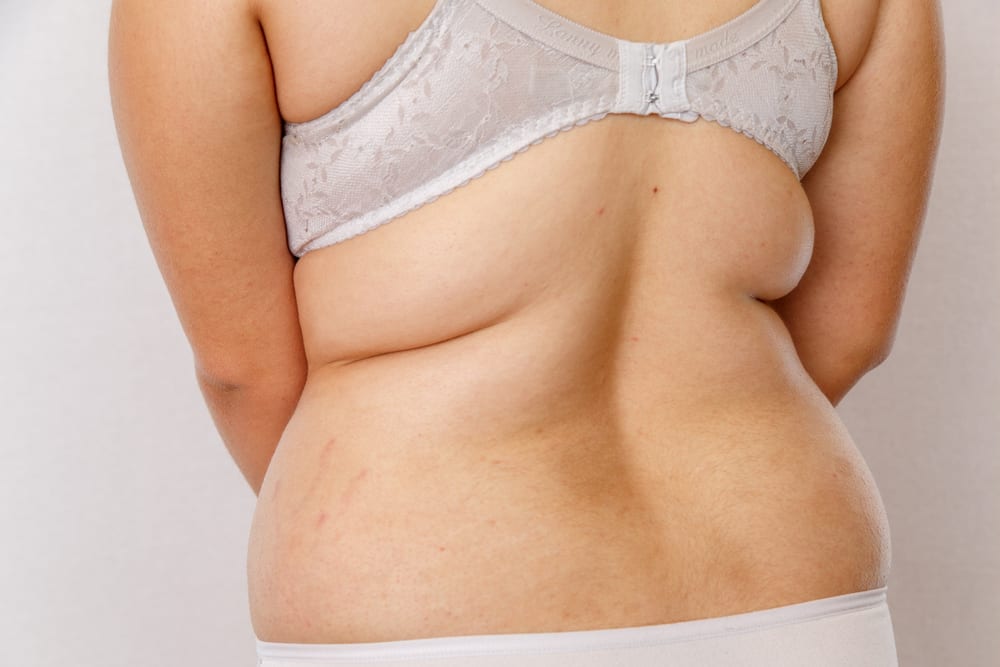 Banish Bra Bulge with Underarm Fat Removal - A New You Aesthetics