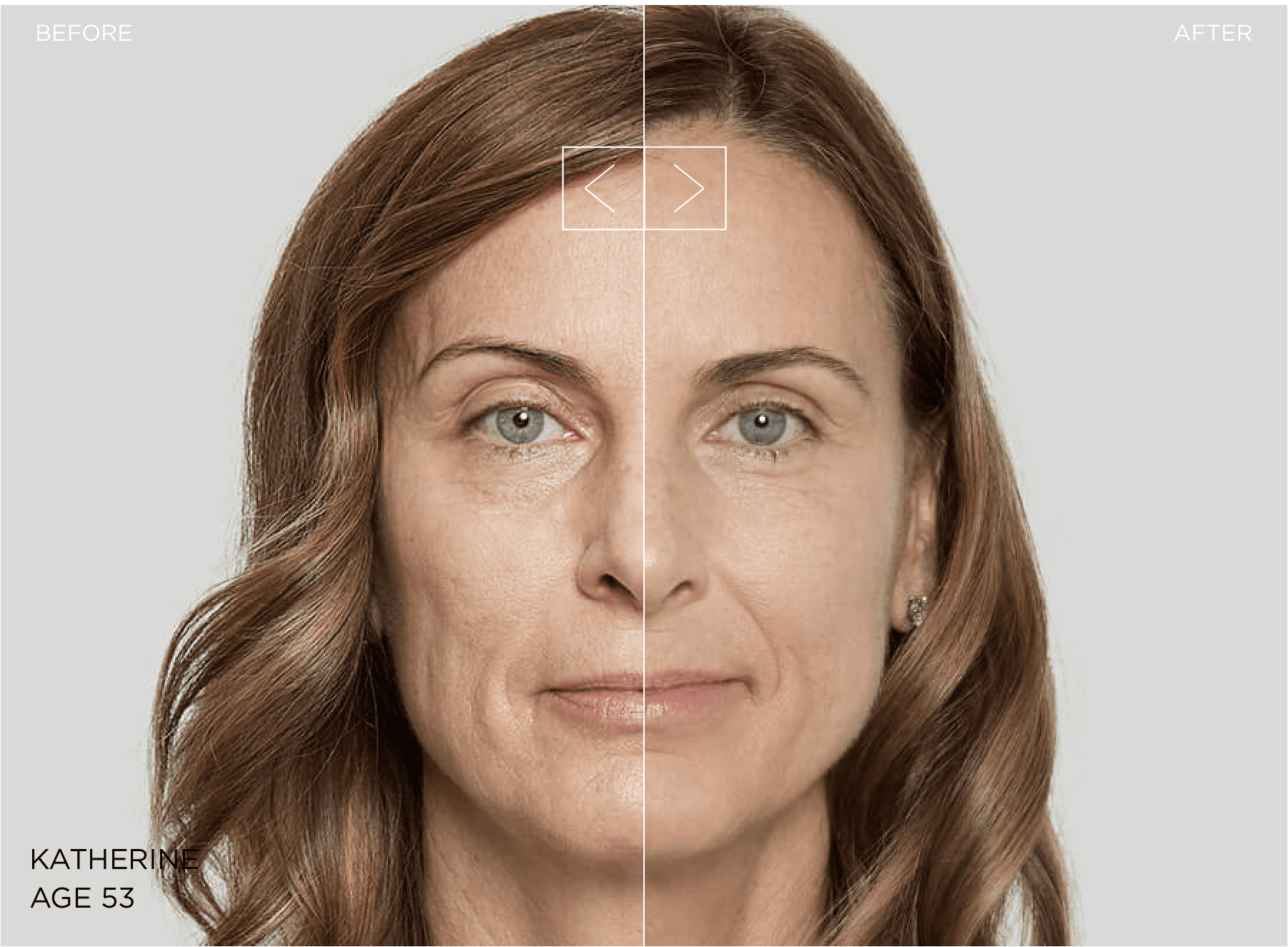 Sculptra Temecula CA