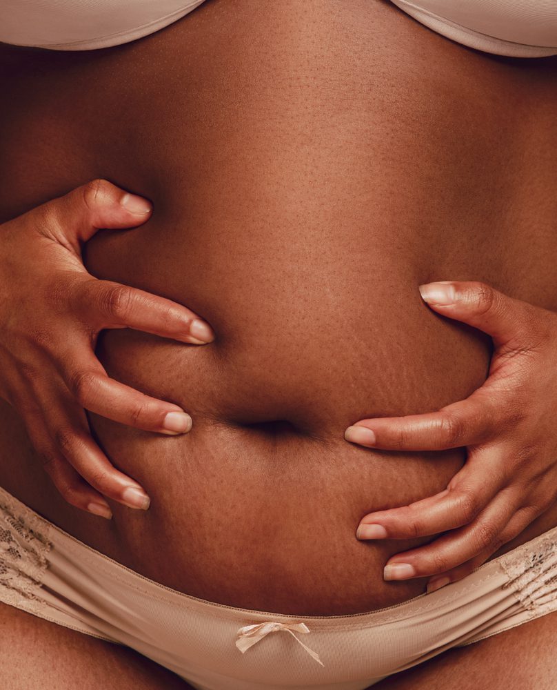 Close,Up,Of,Woman,Pinching,Fat,On,Her,Belly.,Overweight