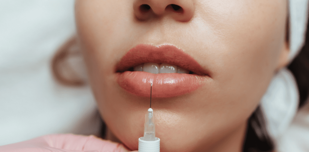 Longest Lasting Lip Fillers in Temecula