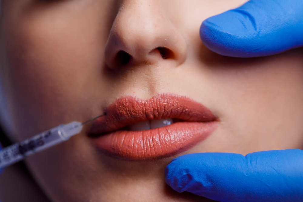 How Much Do Lip Fillers Cost in Wildomar, California for First-Time Patients