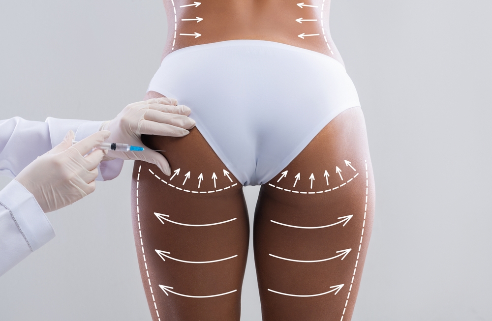 The Definitive Sculptra Butt Lift Overview for Temecula, CA