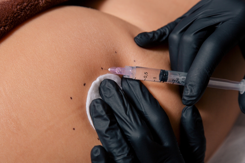Non-Surgical Butt Augmentation in Temecula: Exploring the Bellafill Option