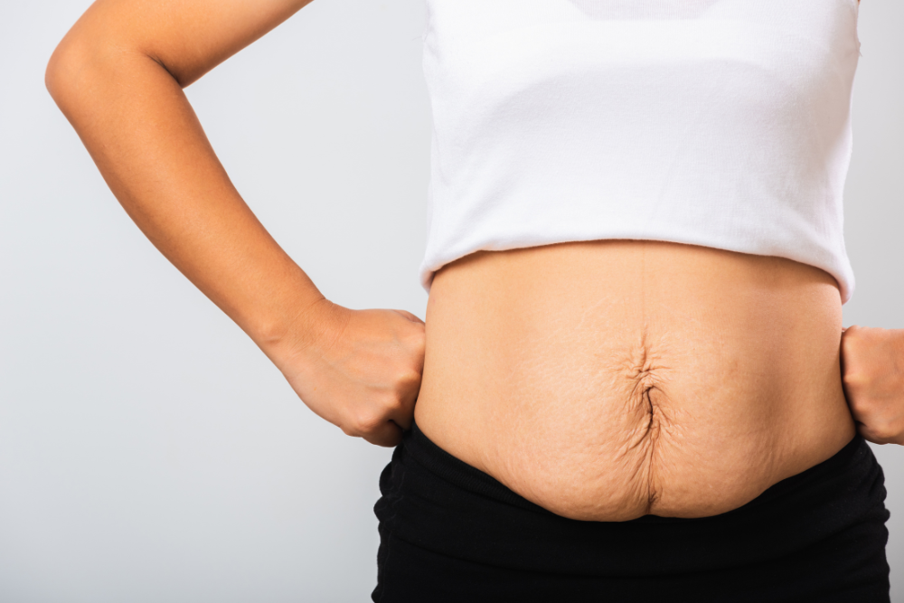 Non-Surgical Tummy Tuck Treatments Near Menifee, CA