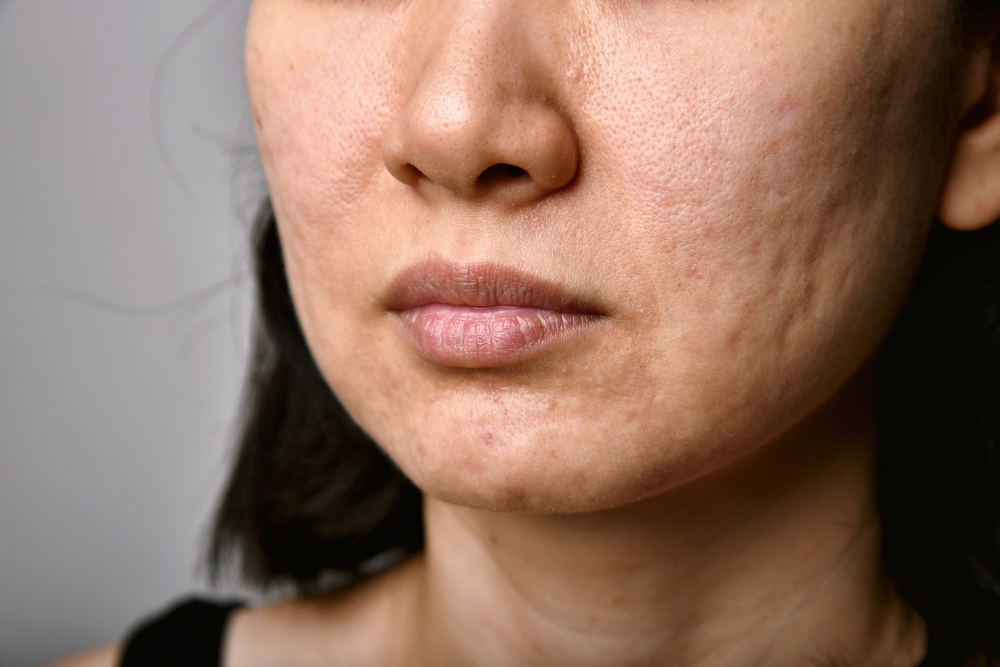 Acne Scar Microneedling Treatments Near Murrieta, CA