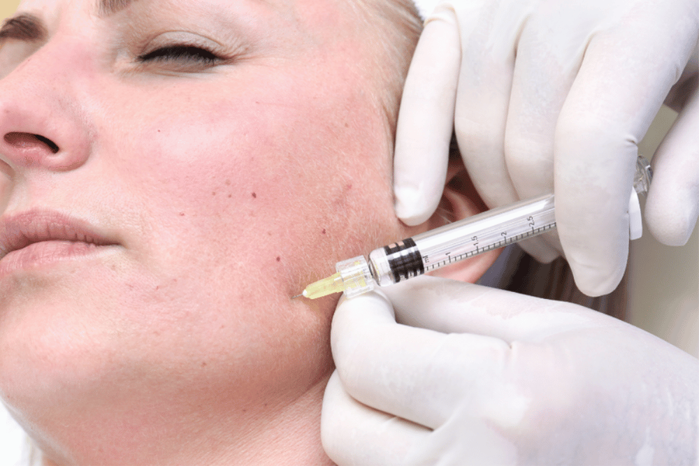 Dermal Fillers in Temecula California
