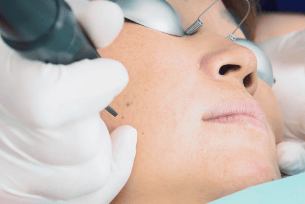 Lasers for Asian skin in Temecula CA