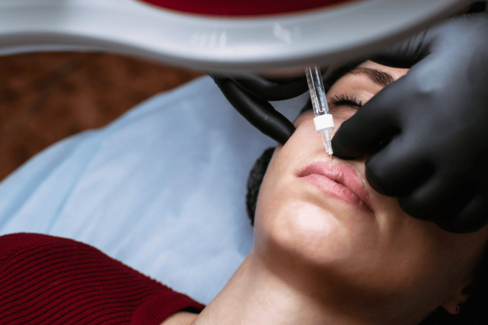 Natural lip fillers in Temecula CA
