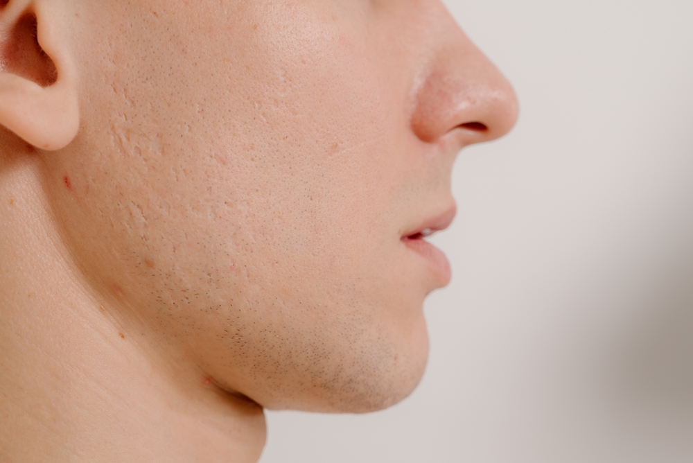 Acne Scars Treatment in Temecula CA