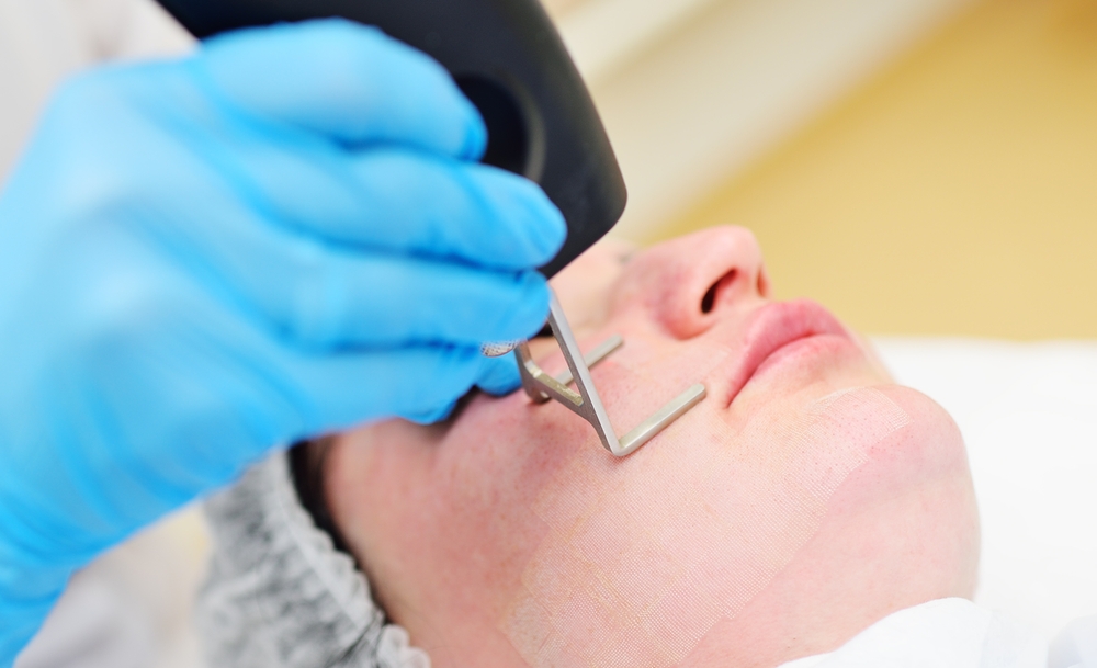 CO2 Laser Skin Resurfacing in Temecula for Wrinkles Acne Scars and Sun Damage
