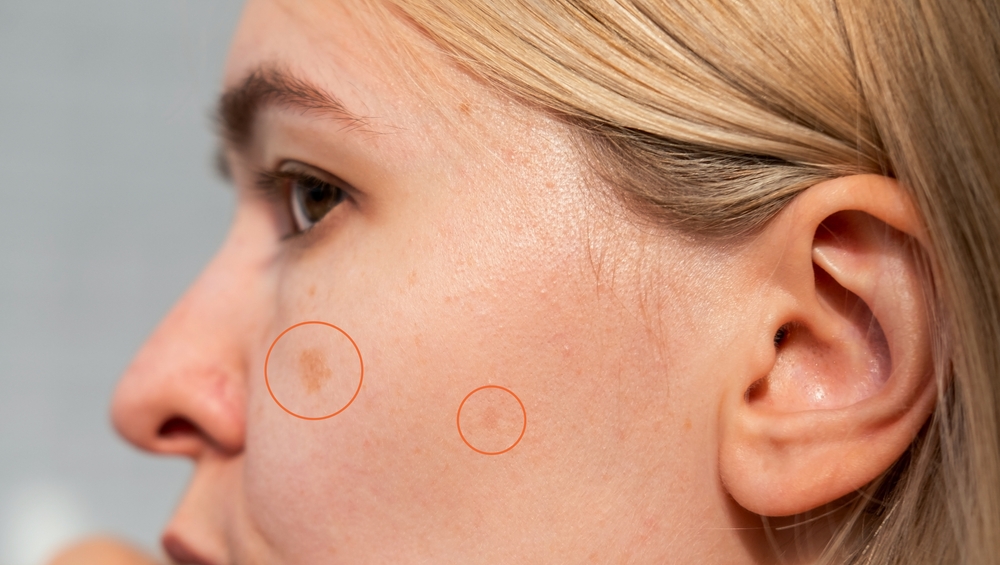 Where Can Patients Find Safe Pico Laser Treatments in Temecula, CA? What to Know About Pico Treatments at A New You Aesthetics