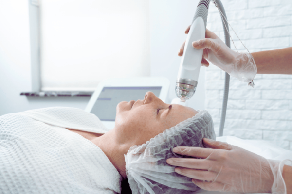 Pico laser for melasma and acne scars in Temecula CA