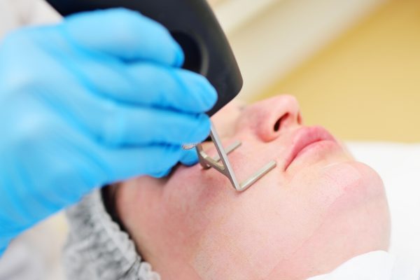 CO2 Laser Skin Resurfacing in Temecula for Wrinkles Acne Scars and Sun Damage