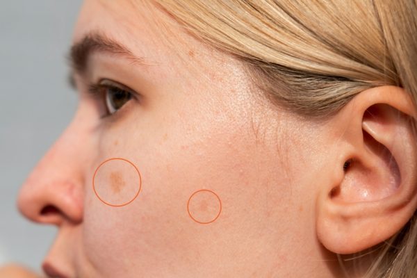 Where Can Patients Find Safe Pico Laser Treatments in Temecula, CA? What to Know About Pico Treatments at A New You Aesthetics